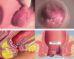 biến chứng nguy hiểm bệnh trĩ ngoại
