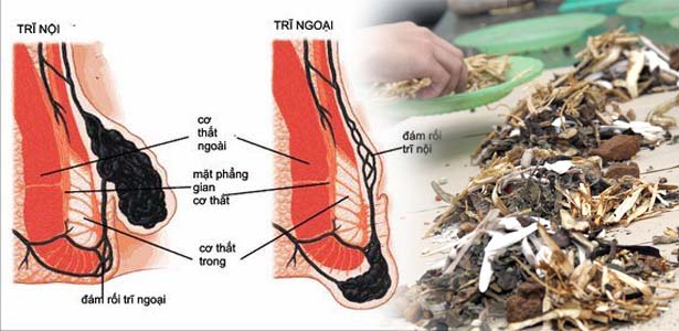 điều trị dứt điểm bệnh trĩ bằng đông y