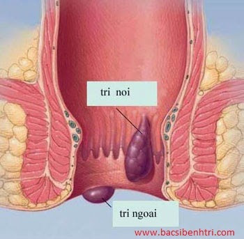 Cách điều trị bệnh trĩ ngoại hiệu quả