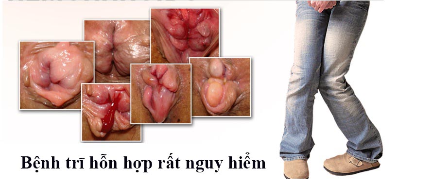 Chữa bệnh trĩ hỗn hợp