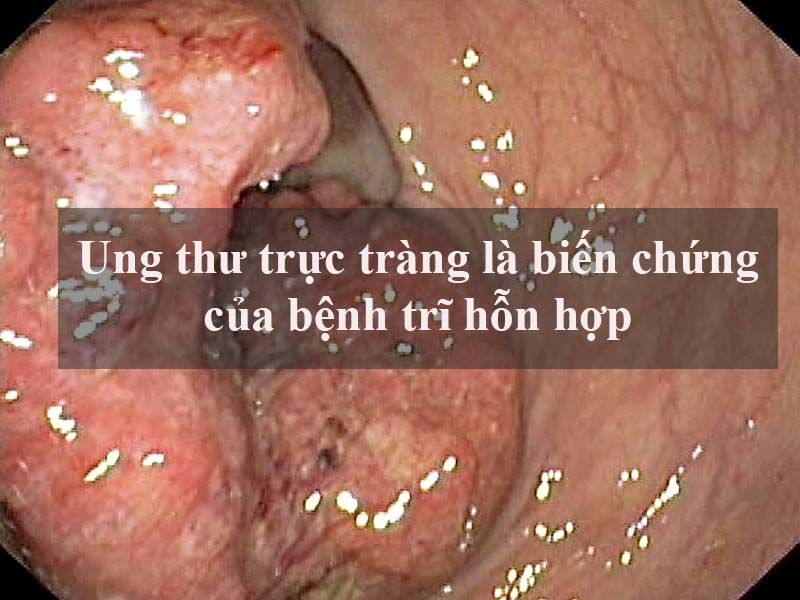 biến chứng trĩ hỗn hợp