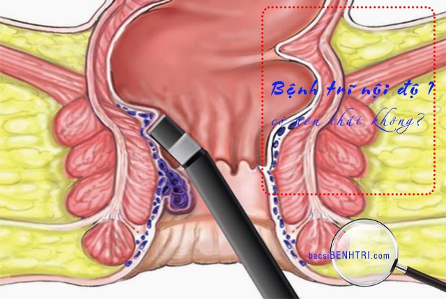 Búi trĩ độ 1 có nên thắt không