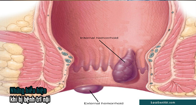 biểu hiện trĩ nội