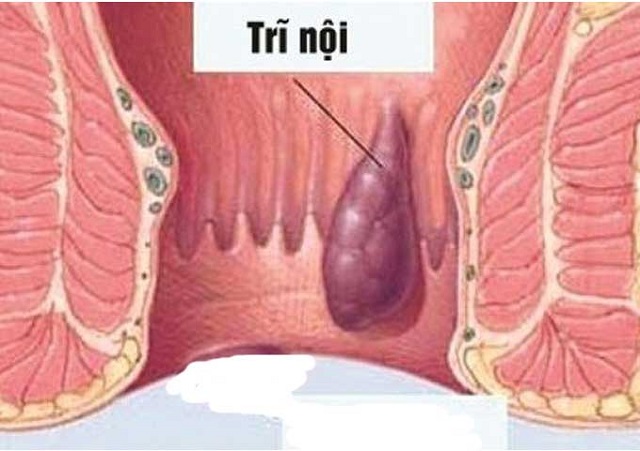 Triệu chứng bệnh trĩ nội Triệu chứng bệnh trĩ nội