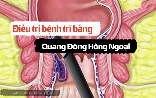 điều trị bệnh trĩ bằng quang đông hồng ngoại 