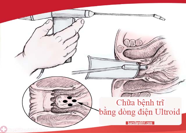 chữa bệnh trĩ bằng dòng điện Ultroid