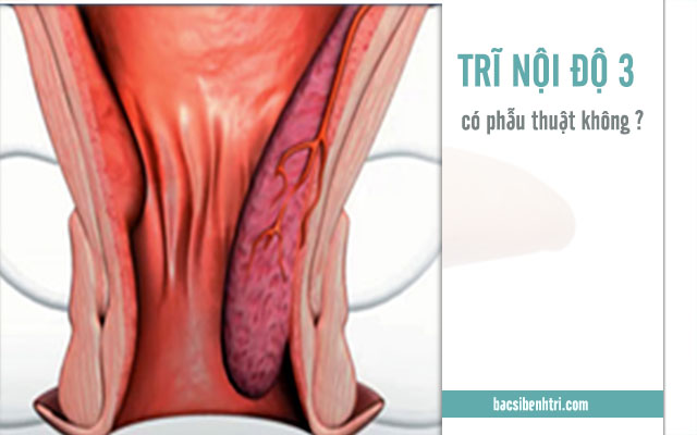 trĩ nội độ 3 có cần phẫu thuật không