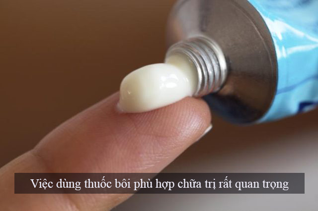 chữa bệnh trĩ bằng thuốc bôi