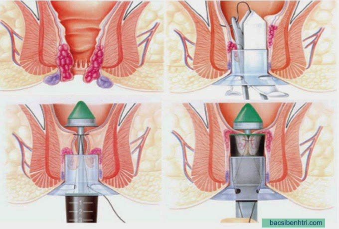 điều trị bệnh trĩ lâu năm