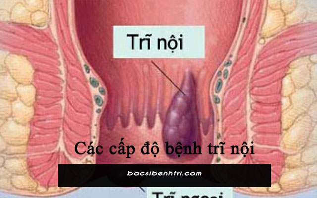 cấp độ trĩ nội