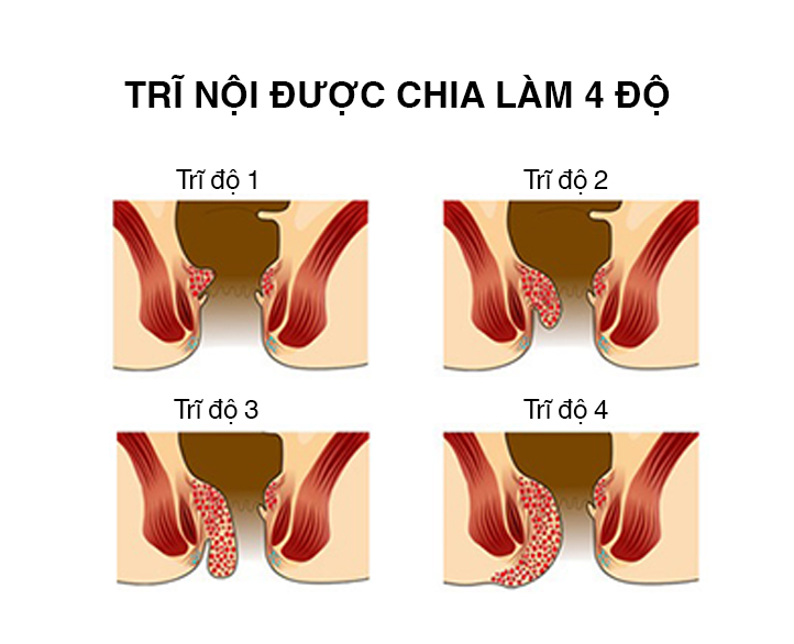 phan-biet-benh-tri-noi-do-1-2-3-va-huong-dieu-tri