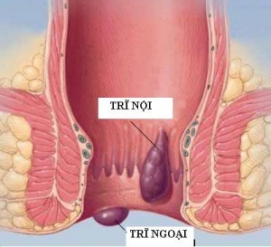 phan-biet-dau-hieu-benh-tri-noi-va-benh-tri-ngoai