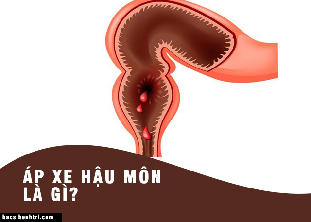 Áp xe hậu môn