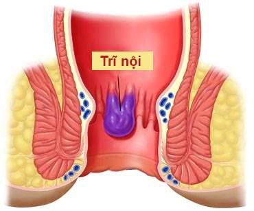 benh-tri-noi-tri-ngoai-la-gi-va-cach-nhan-biet