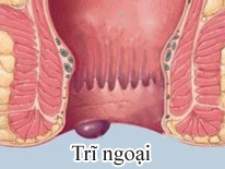 benh-tri-noi-tri-ngoai-la-gi-va-cach-nhan-biet1