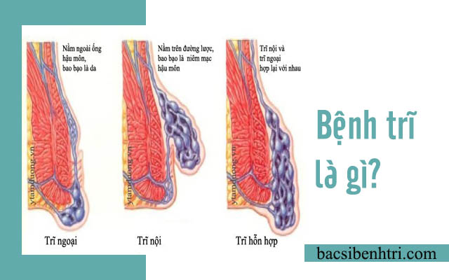 bệnh trĩ là gì