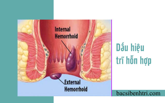 dấu hiệu bệnh trĩ