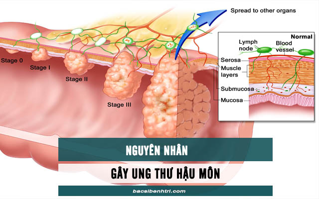 nguyên nhân gây ung thư hậu môn