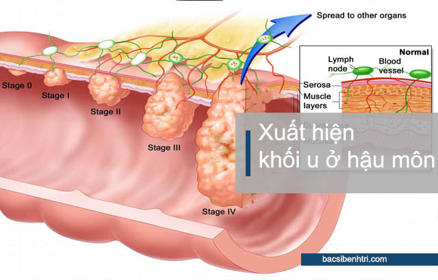 triệu chứng ung thư hậu môn