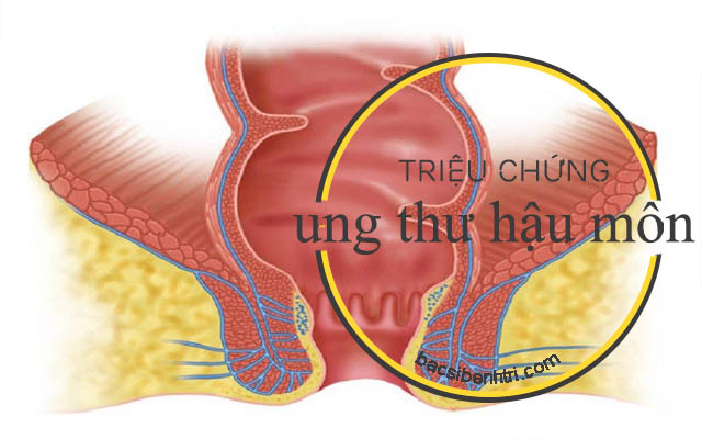 triệu chứng ung thư hậu môn