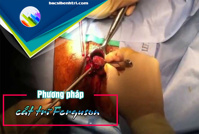 Phương pháp cắt trĩ Ferguson