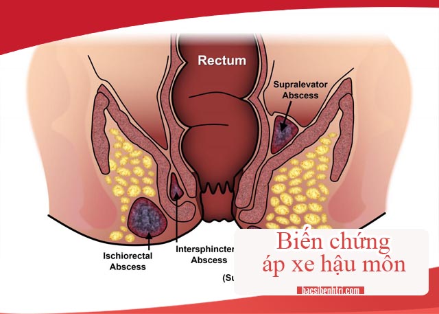 biến chứng áp xe hậu môn