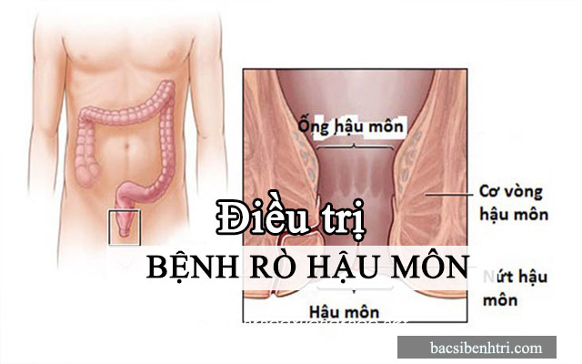 điều trị rò hậu môn