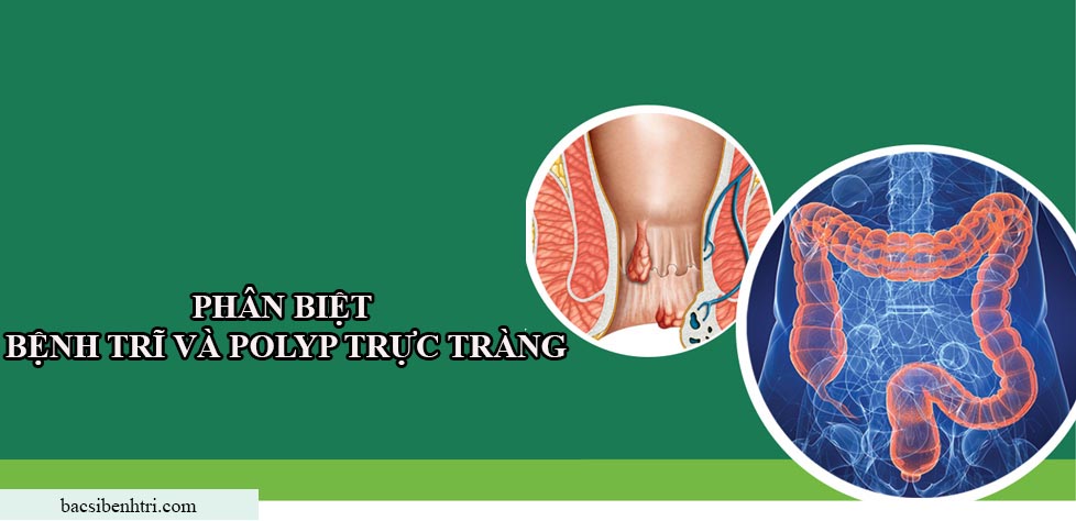 phân biệt bệnh trĩ hay polyp trực tràng