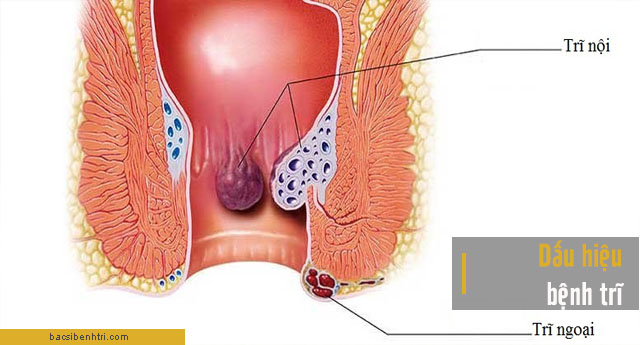 phân biệt bệnh trĩ hay polyp trực tràng