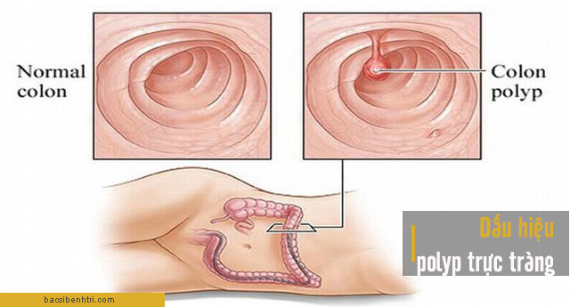 phân biệt bệnh trĩ hay polyp trực tràng