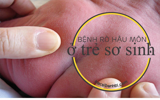 trẻ sơ sinh bị rò hậu môn