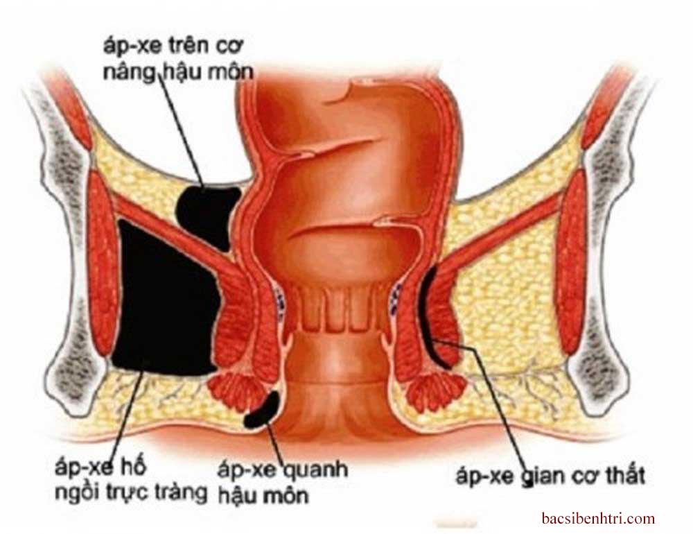 Địa chỉ khám áp xe hậu môn