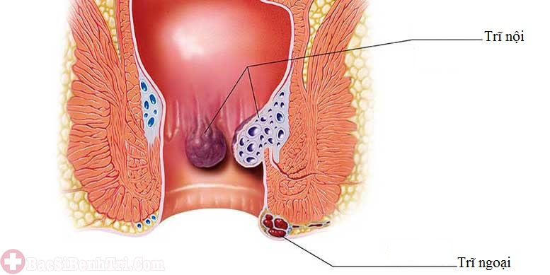 chữa bệnh trĩ nội độ 1