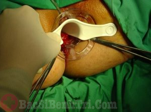 Giải đáp: Bị mắc bệnh trĩ hỗn hợp có nên phẫu thuật hay không?