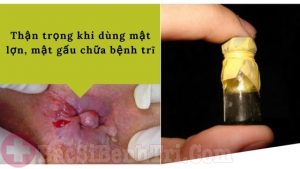 Thận trọng khi dùng mật lợn, mật gấu chữa bệnh trĩ