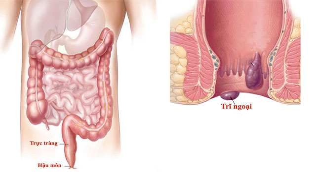 Bệnh trĩ ngoại Cách chữa bệnh trĩ ngoại