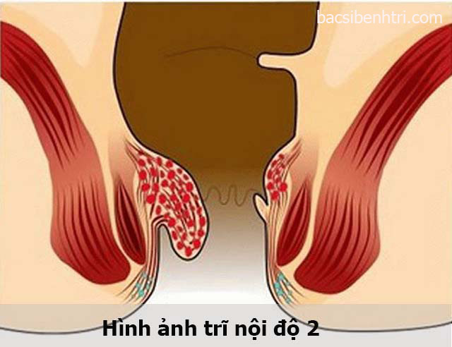 bệnh trĩ nội độ 2