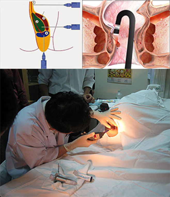 Dùng laser chữa trĩ nội