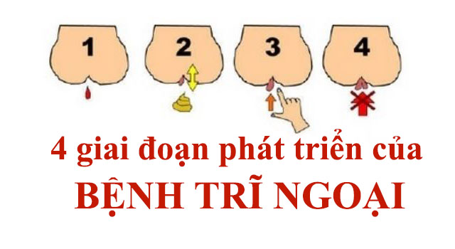 Ảnh nhận biết bệnh trĩ ngoại hình ảnh bệnh trĩ ngoại