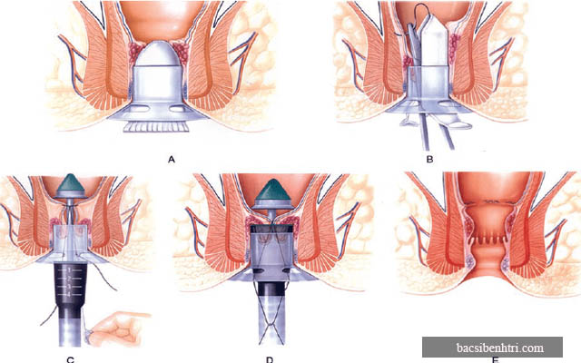 phẫu thuật cắt trĩ theo phương pháp Longo