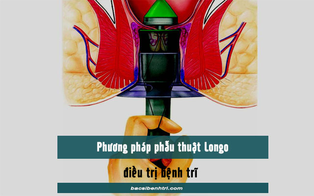 phương pháp phẫu thuật trĩ