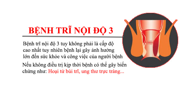 Bệnh trĩ nội độ 3