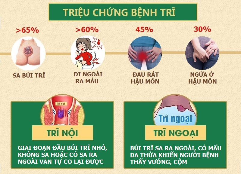 Dấu hiệu bệnh trĩ