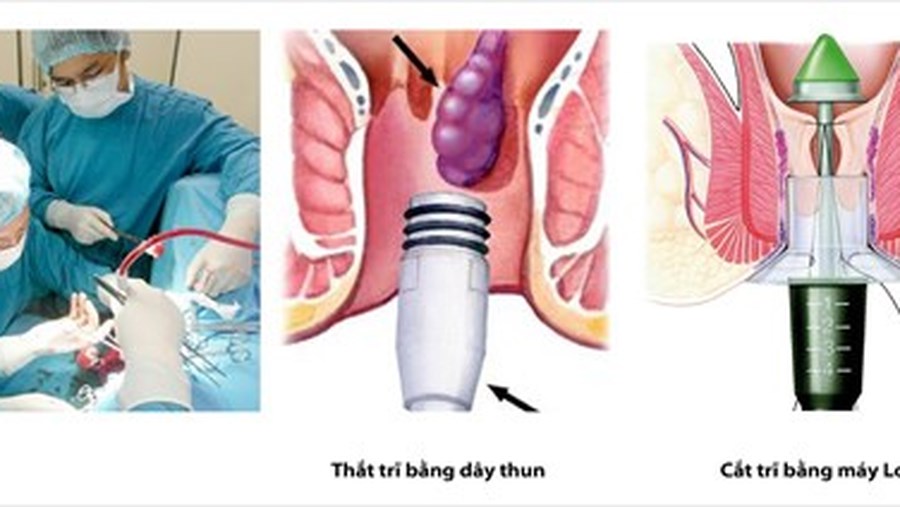 điều trị bệnh trĩ