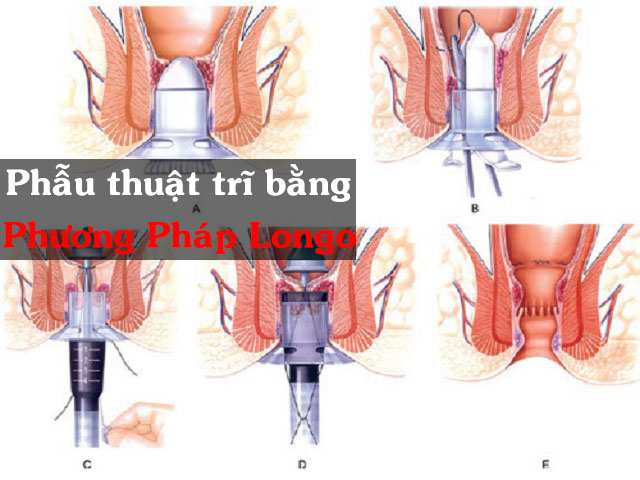 Hình ảnh phẫu thuật trĩ bằng longo