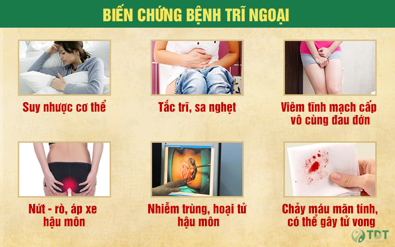 Những biến chứng nguy hiểm khi bệnh trĩ trở nặng