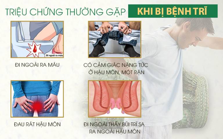 Dấu hiệu nhận biết bệnh trĩ ngoại