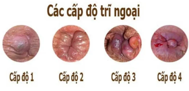 Hình ảnh các cấp độ của trĩ ngoại