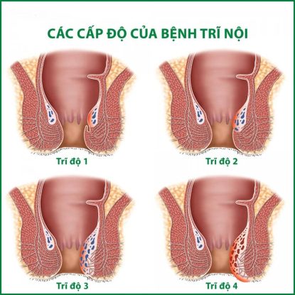 Hình ảnh các cấp độ của trĩ nội