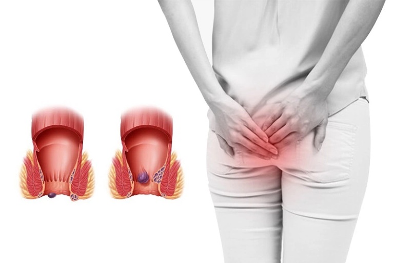 Bệnh trĩ xảy ra phổ biến ở chị em phụ nữ sau sinh